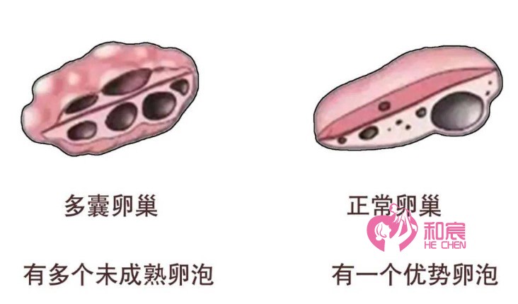 肥胖多囊卵巢怎么调理才能好，多囊卵巢调理妙招